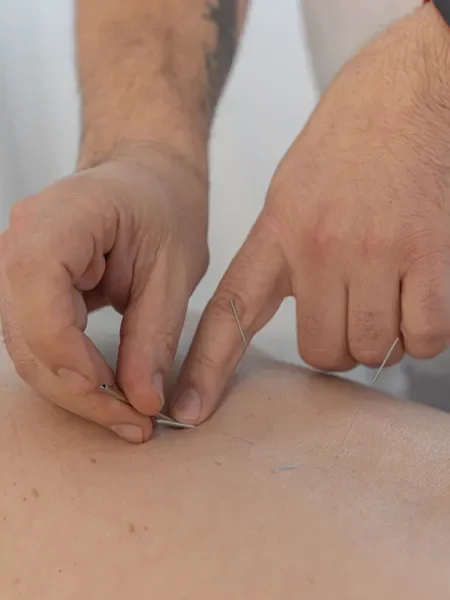 טיפול דיקור סיני למיגרנות מקצועי